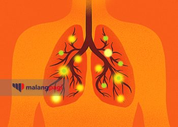 Pasca Pandemi Covid-19, Kota Malang Diintai Wabah Pneumonia